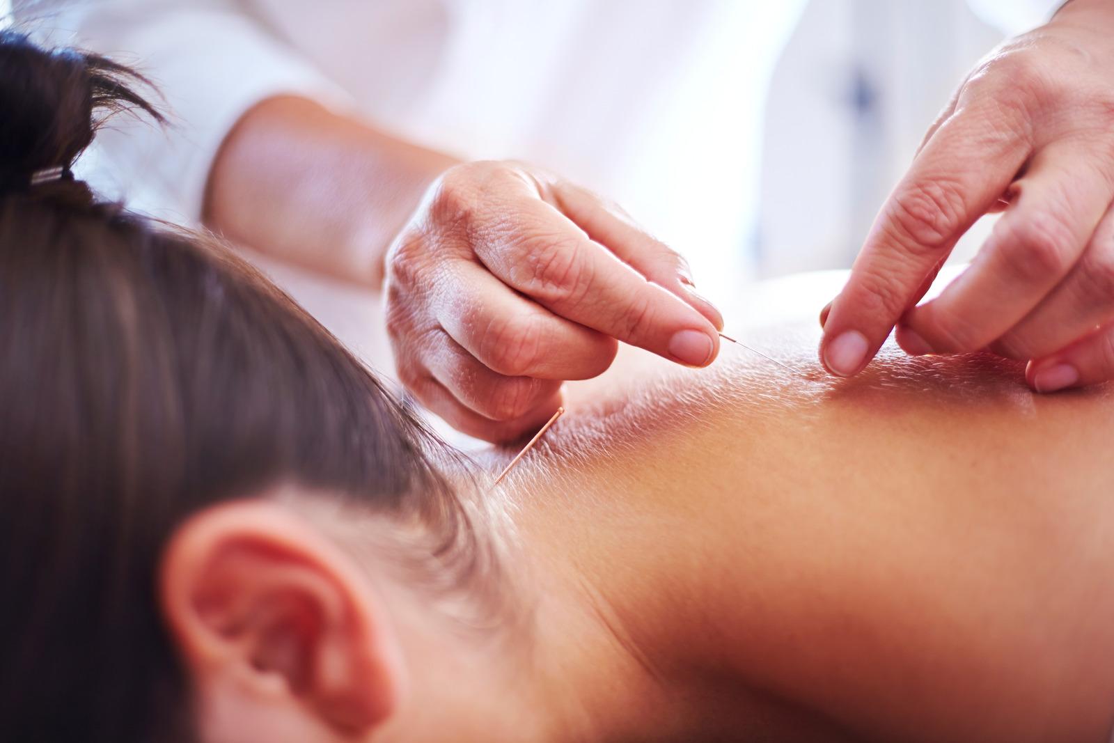 Acupuncture Treatment for Neck Pain in Dubai at Beijing Acupuncture Dubai