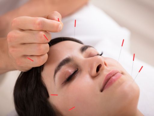 Bell’s Palsy Treatment in Dubai with Acupuncture