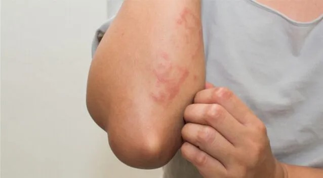 Eczema Treatment Dubai