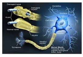 Diagram of demyelination in MS — immune cells stripping the myelin sheath from a nerve, disrupting signal transmission.