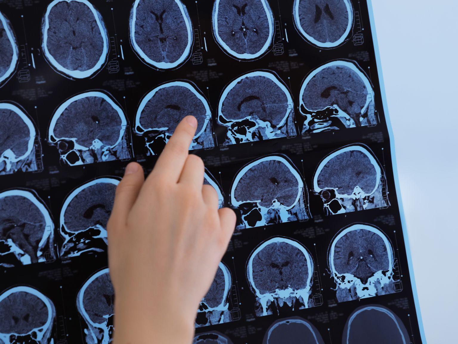 MRI scan and neurological testing used for multiple sclerosis diagnosis